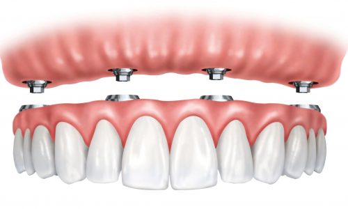 Hybraid dentures1